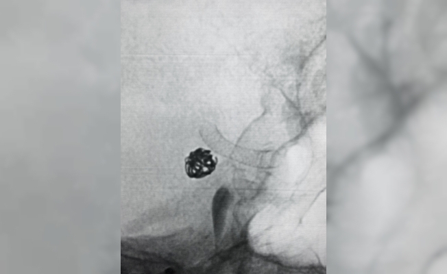 Beyin kanaması geçiren hastaya akım çevirici stent takıldı